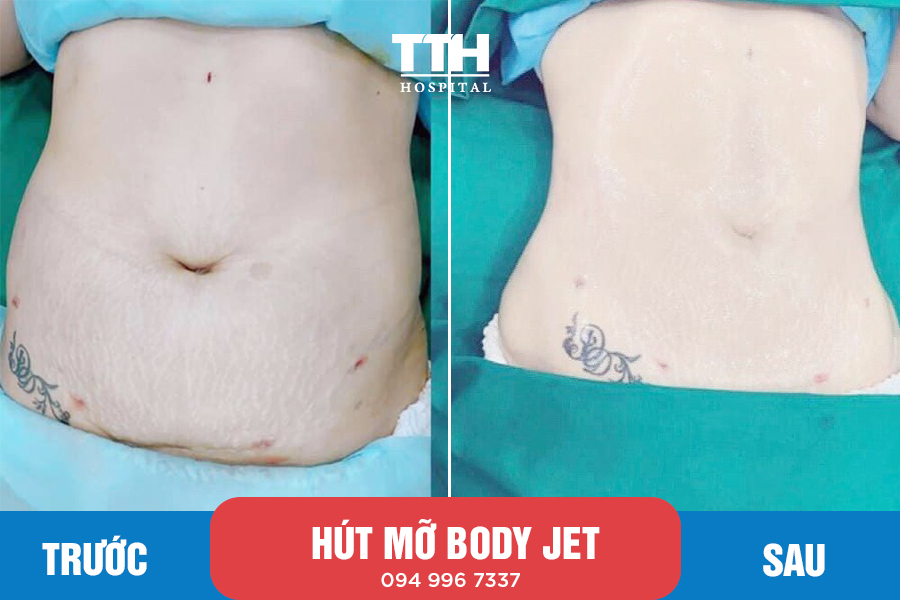 Hút mỡ công nghệ tia nước Body-Jet:
